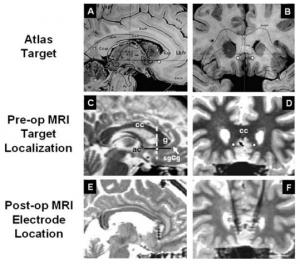 This image shows a sagittal view of the brain (left column) and coronal views (right column), of the areas targeted by DBS techniques, with the lower two images showing the implantation of the electrodes.