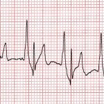 Canine Right Atrial Enlargement 25mm/sec