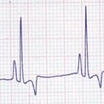 Canine Right Atrial Enlargement 25mm/sec