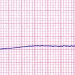 Canine Sinus Arrest 25mm/sec