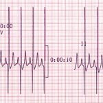 Canine Bi-ventricular Enlargement 25mm/sec