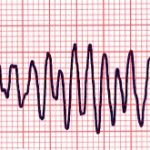 Canine Ventricular Fibrillation 25mm/sec