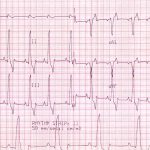 Canine Left Bundle Branch Block 50mm/sec