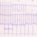 Canine Left Ventricular Enlargement 50mm/sec