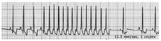 typical ccw atrial flutter icd 10