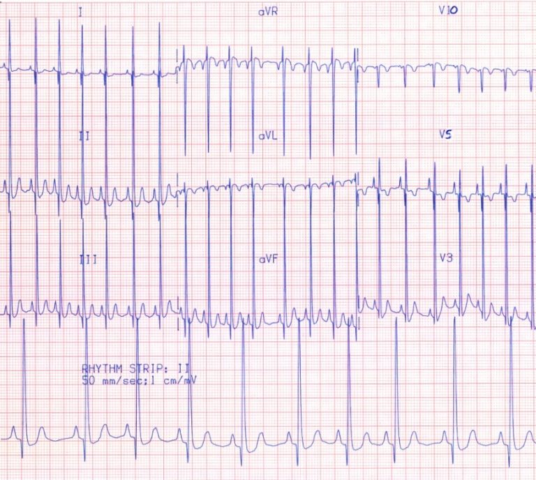 Faculty Syllabus: Electrocardiography II- Hypertrophy and Enlargement ...