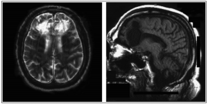Frontal Lobotomy. Axial and sagittal views of a lobotomy. Notice the diffuse damage in the images, most notably the bright white swath across both hemispheres on the left. (Lapidus, 2013).