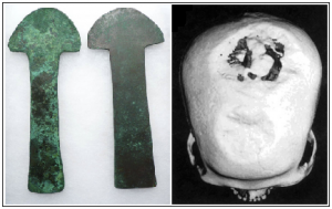 Trepanning: Trepanning was a widespread phenomenon. The left image shows tools used in the procedure from South America in the first millennium. The right image show a Neolithic skull from 5100 with evidence of the procedure (Robinson et al., 2012)