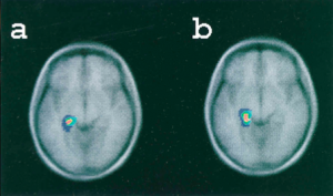 Figure 1: Blood flow increases in the left medial temporal lobe during both true recognition and false recognition. (Credit: Schacter et al. 1996) 