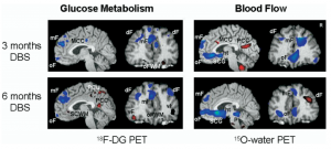 This images shows changes in oxygen and other metabolic usage in different areas of the brain following chronic DBS treatment