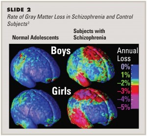MRI Images of progressive Gray matter loss in the brains of boys and girls. http://www.cnsspectrums.com/aspx/articledetail.aspx?articleid=1286 