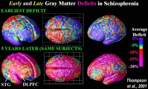 Image of gray matter loss after 5 years in the same subjects. http://users.loni.usc.edu/~thompson/J/5A.jpg