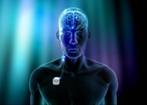 Libra-Deep-Brain-Stimulation